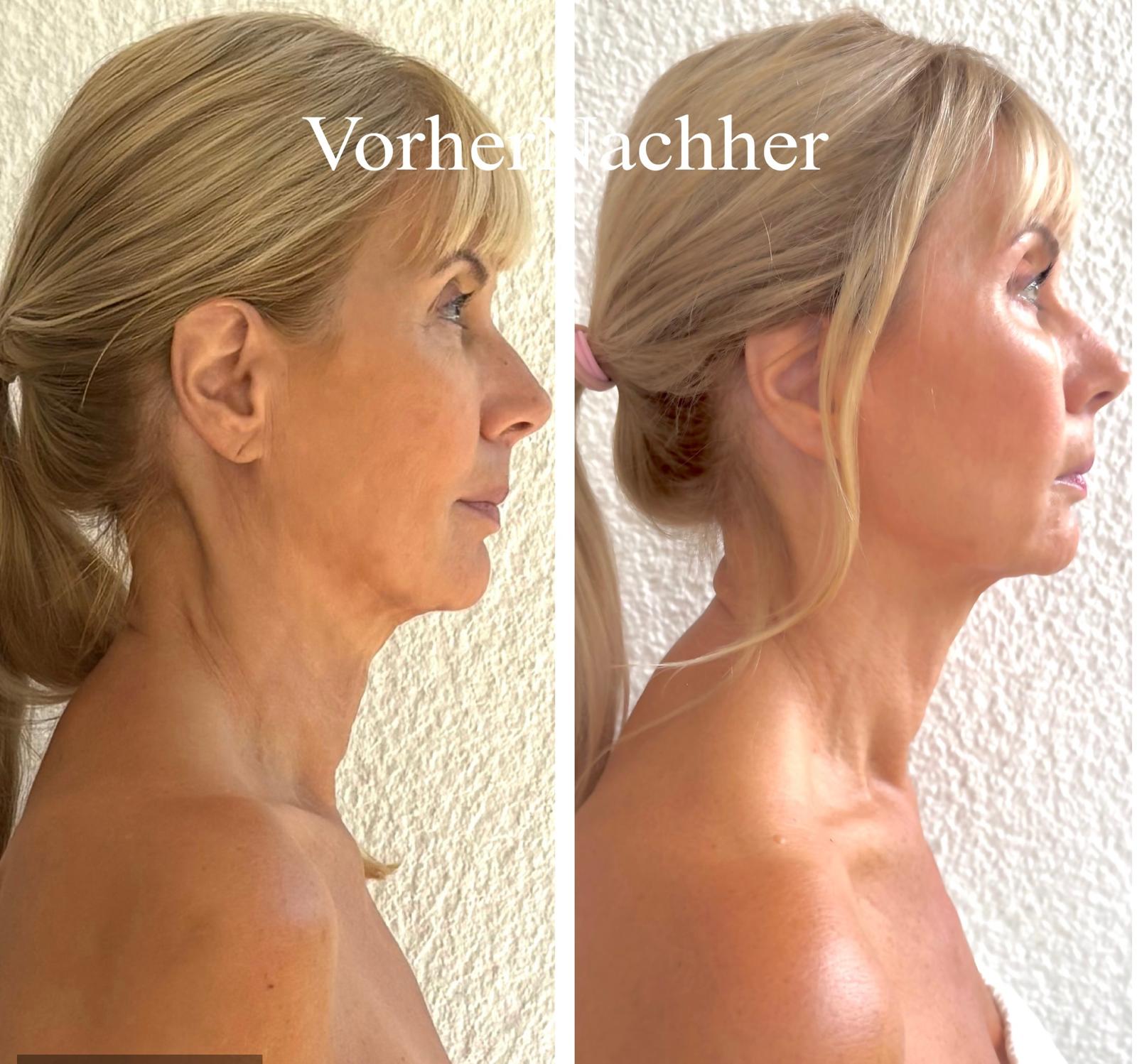 Vorher-Nachher Vergleich rechte Seite
