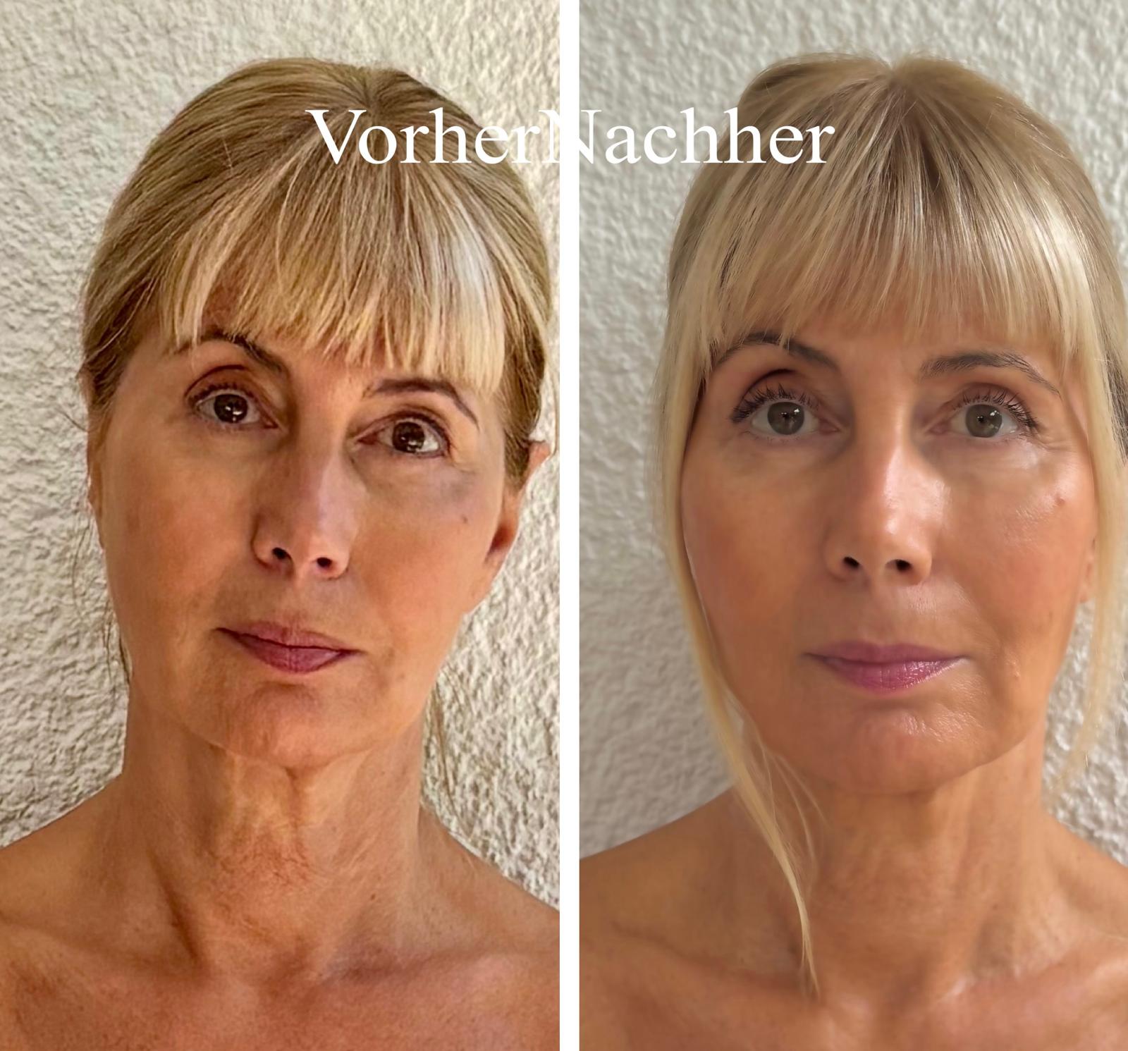 Vorher-Nachher Vergleich frontal